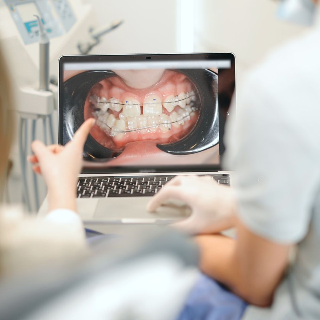 Before and after smile transformation with braces treatment